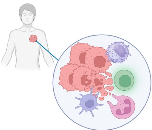 AdCab injected into a patient travels to the tumor and turns tumor cells into biofactories producing a PD-L1 targeted peptide